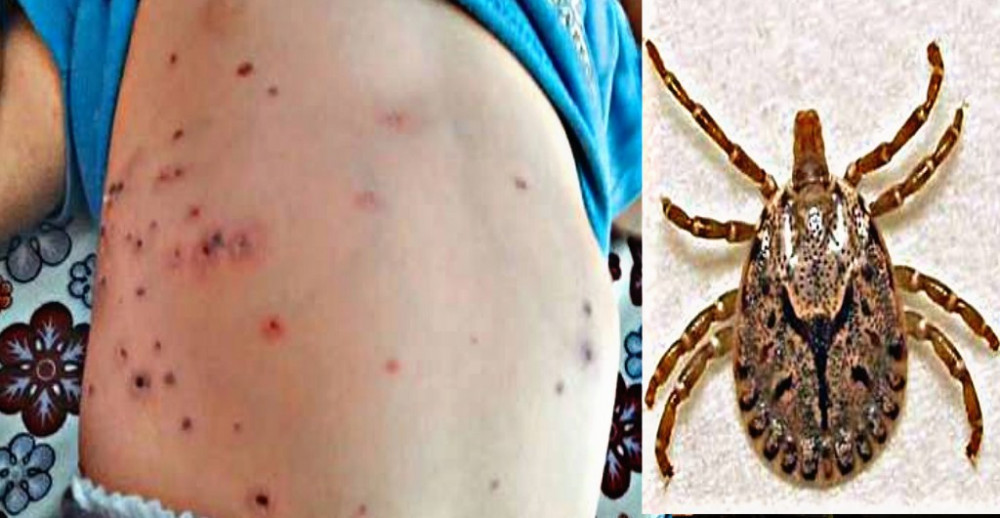 ६३ जिल्लामा स्क्रब टाइफस, बाह्र सय संक्रमित