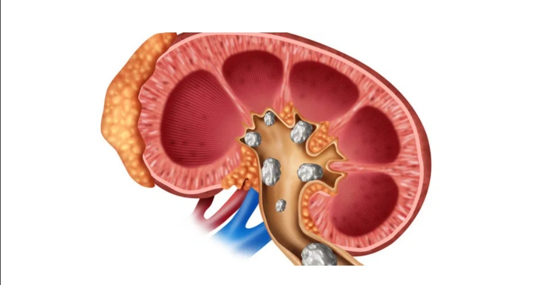 मिर्गौलामा पत्थरी हुनुको मुख्य कारण के हो?