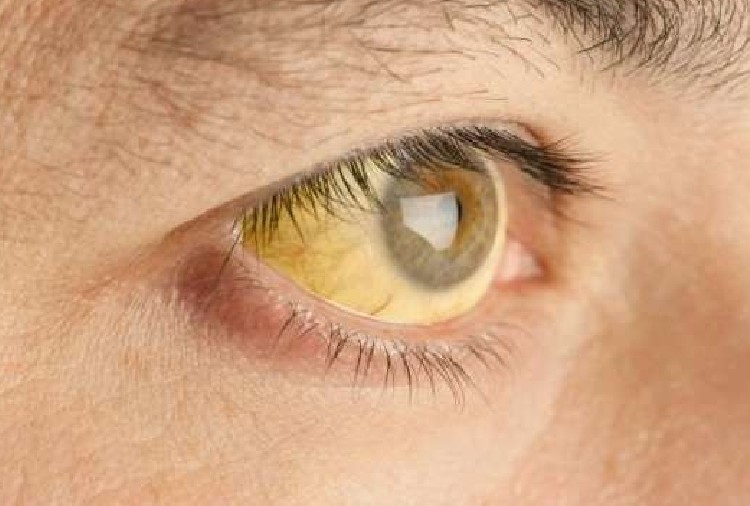 के योगले जन्डिस कम गर्न सकिन्छ?