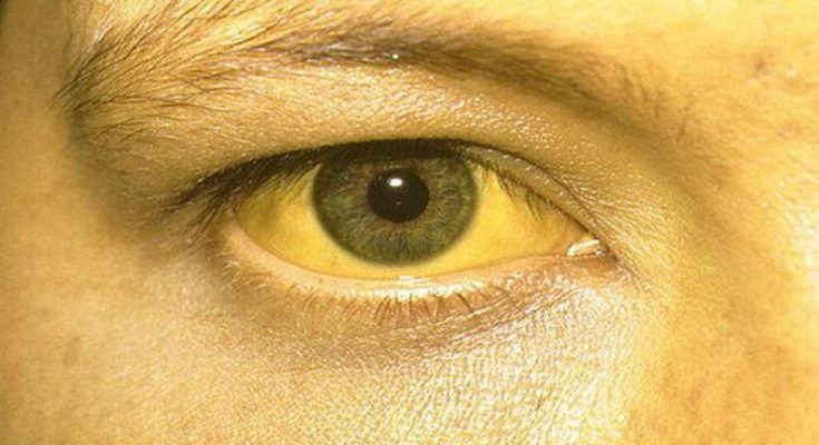 के योगले जन्डिस निको हुन्छ?