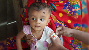 मधेसका १६ प्रतिशत बालबालिकामा कुपोषण