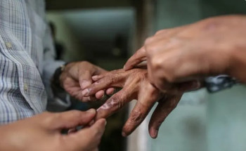 चितवनमा १८ जनामा कुष्ठरोगको संक्रमण