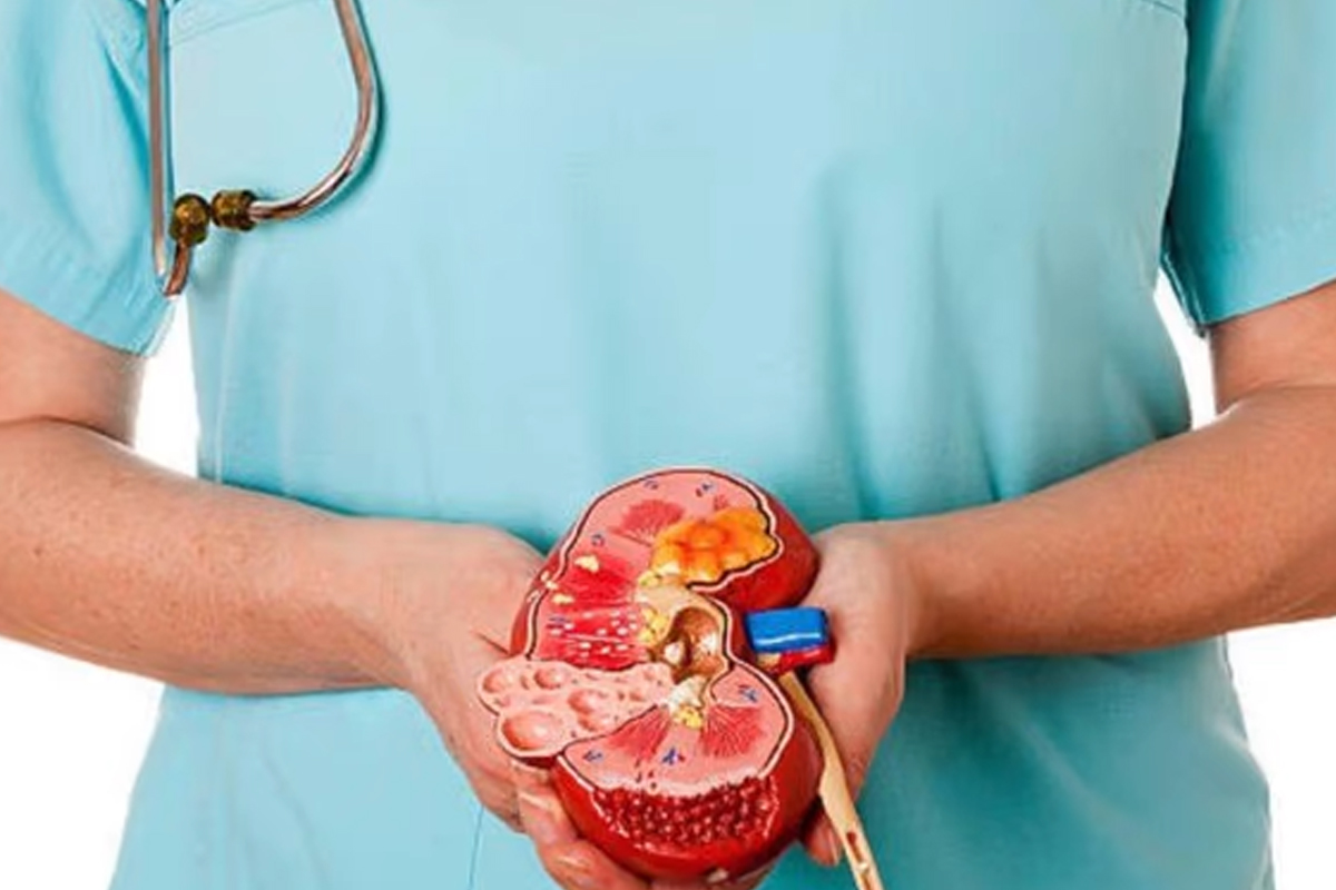 मिर्गौलाको पत्थरीबाट बच्न के गर्ने के नगर्ने?