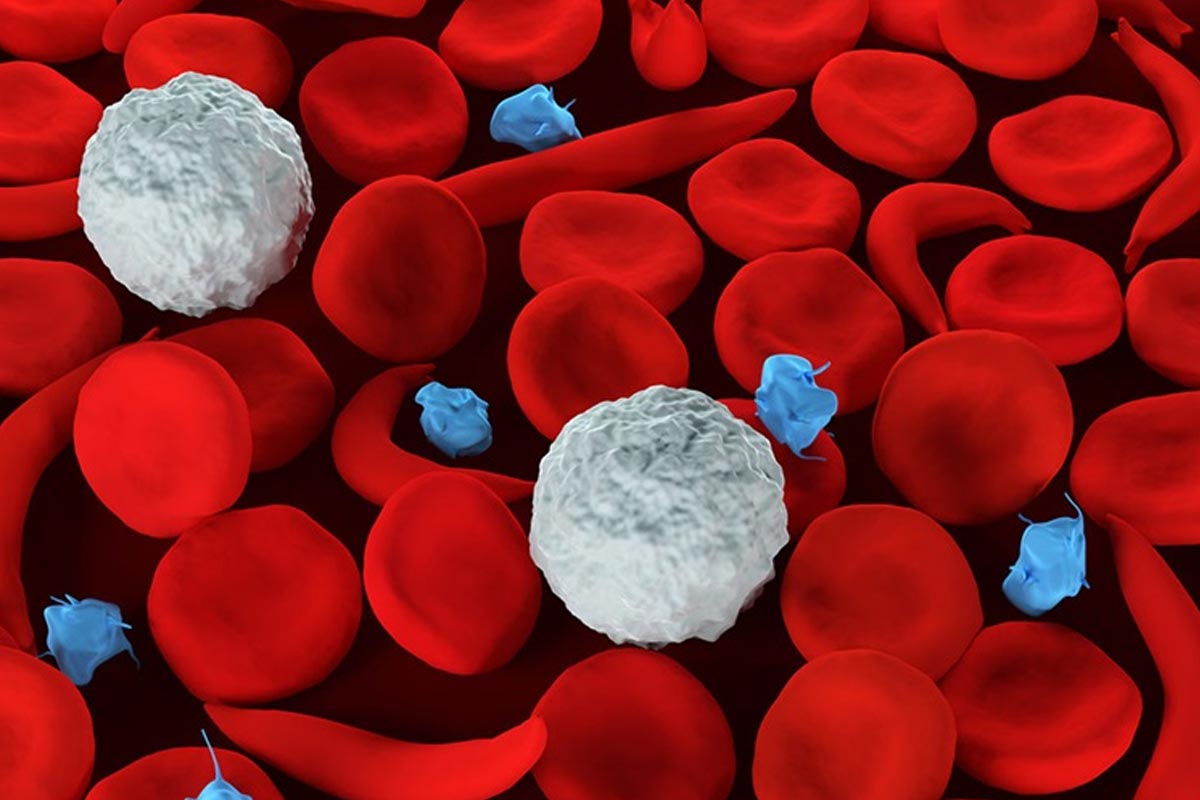 १० हजार नमूना परीक्षणमा ४४ जनामा सिकलसेल