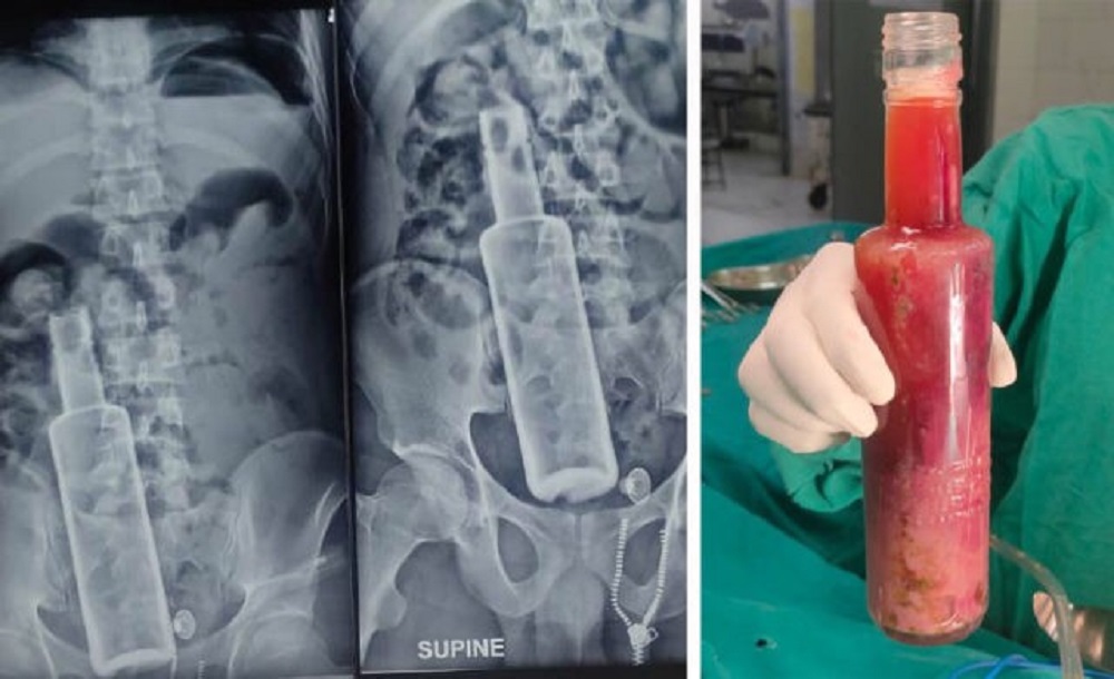 २६ वर्षीय युवकको पेटमा रक्सीको बोतल, चिकित्सकले गरे सफल शल्यक्रिया